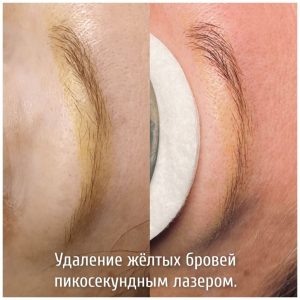 Удаление татуажа в Оренбурге