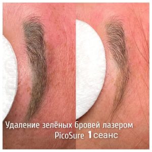 Удаление татуажа в Оренбурге