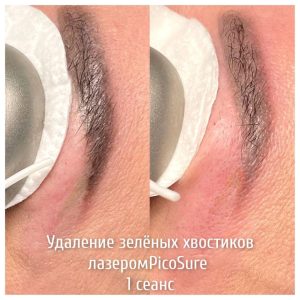 Удаление татуажа в Оренбурге